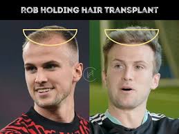 Rob Holding Hair Transplant
