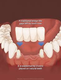 How many teeth can be on a bridge. Implant Supported Bridge For The Front Teeth Harrisonburg Va
