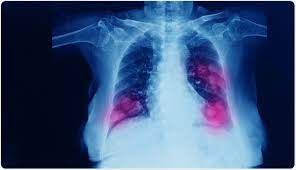 Metastatic Lung Cancer