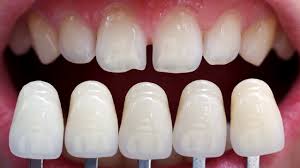 Faq What Are Veneers Dental Designs Of New England
