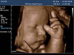 Da ist dein kind bereits klar als baby zu erkennen, ist aber noch klein genug, dass es in großem umfang auf den bildschirm. Leistungen Frauenarzte Saarbrucken West