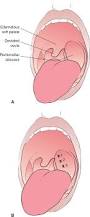 Image result for Peritonsillar Abscess