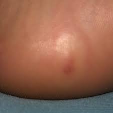 Image result for spinne biss haut reaktion