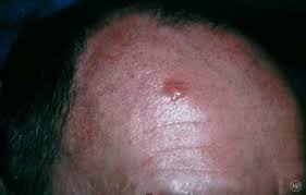 There are three types of skin cancer: Basal Cell Carcinoma Dermatologist In Wellesley Ma
