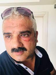 Kucucuk Sivrisinek Mehmet Beyi Bu Hale Getirdi Kocaeli Gazetesi