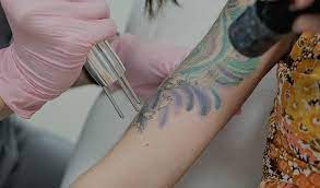 Follow evolution laser on facebook for all the latest specials and deals! Best Laser Tattoo Removal Randwick Skinnovation Laser Clinic