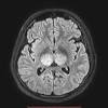 Neonatal herpes simplex encephalitis is caused by vertical transmission of infection during passage from birth canal with diffuse cerebral involvement within the first month after birth; Https Encrypted Tbn0 Gstatic Com Images Q Tbn And9gcrdxy3z2eym11k598x Gpw 80uutrfdspfukdrx9y Usqp Cau