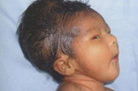 Image result for Cephalhematoma