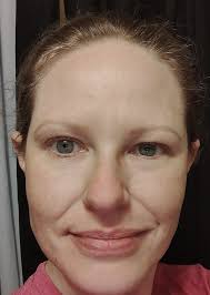 Can I get blepharoplasty at 50?