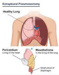 The surgeon makes 3 small wounds, each about an inch long. Pleural Mesothelioma Symptoms Diagnosis And Treatment