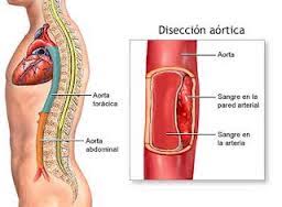Se originan en la aorta torácica y se extienden hasta la aorta abdominal. Aneurisma Aortico Ecured