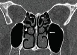 Cribriform plate of the ethmoid. Paranasal Sinus Anatomy What The Surgeon Needs To Know Intechopen