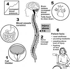 How Do Spinal Cord Injuries Affect The Body University Of Iowa Hospitals Clinics