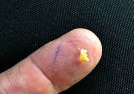 Are You The Cameraman Popcorn Husk Or Crumb Stuck In My Tonsil Throat For A Week