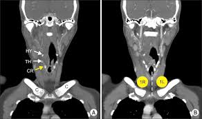 More images for supraclavicular lymph nodes ct » The International Association For The Study Of Lung Cancer Lymph Node Map A Radiologic Atlas And Review Abstract Europe Pmc