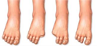 Image result for toe amputation