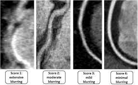 Objective And Subjective Image Quality With Prospectively Gated Versus Ecg Controlled Tube Current Modulation Using 256 Slice Computed Tomographic Angiography Sciencedirect