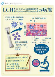 lchの病態 infographics ランゲルハンス細胞 生理学 歯学