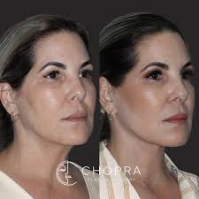 Welcome to another episode of Myth-Busting Fridays! 🧐 Myth: Labiaplasty is  only for aesthetic reasons. 💡 Truth: While it's a cosmetic procedure,  labiaplasty offers real functional benefits that patients love. Let's break