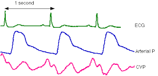 Sometimes an ekg abnormality is a normal variation of a heart's rhythm, which does not affect your health. Abnormal Ekg S And Corresponding Arterial Waveforms