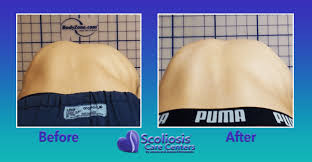 Alibaba.com offers 1,030 rib cage products. Scoliosis Rib Hump Results Scoliosis Care Centers