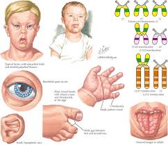 Maybe you would like to learn more about one of these? Trisomy 21 Clinical Gate