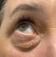 Image result for xanthelasma of eyelid