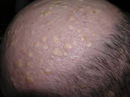 3 in the very occasional instances when multiple proliferating. Localized Forms Of Steatocystoma Multiplex Case Report And Review Of The Literature