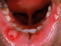 Image result for Canker sores symptoms roof of the mouth