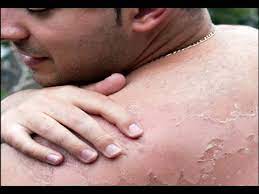 Super itchy sunburns actually have a name—hell's itch—which would be kinda funny if you weren't currently living through it. How To Relieve Sunburn Itch From Tanning Bed Youtube