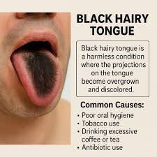 Image result for black hairy tongue symptoms