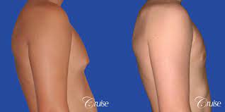 Gynecomastia Before & After Gallery: Patient 80
