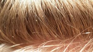 Image result for lice vs dandruff