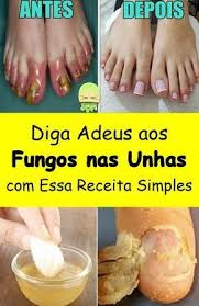 Es posible que una uña infectada se separe del lecho ungueal. Os 11 Remedios Caseiros Para Eliminar Micose Salvabrani Remedio Para Hongos Eliminar Hongos Eliminar Hongos De Las Unas