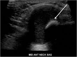 This study was done to evaluate the use of ultrasound to examine lymph nodes in the neck in surgical planning for thyroid cancer surgery and to identify which patients are best served. Thyroglossal Duct Pathology And Mimics Insights Into Imaging Full Text