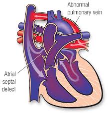 Www.youtube.com/anomaly www.twitch.tv/anomaly www.twitter.com/anomalyxd stream tracks and playlists from anomaly on your desktop or mobile device. Total Anomalous Pulmonary Venous Connection Tapvc American Heart Association