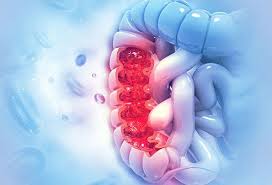 Irritable bowel syndrome (ibs) is a chronic disorder of the large intestine, also known as the colon. Anal Cancer Symptoms Causes Treatment Stages Curable