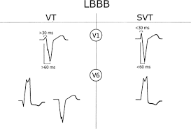 Image result for QRS Complex