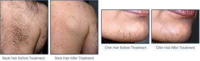 The lasers designed for hair removal can be used on most parts of the body. Dermatology Associates Of Southern New Hampshire Laser Hair Removal Dermatology Associates Of Southern New Hampshire