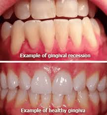 Gingivitis means inflammation of the gums, or gingiva. 5 Things You Should Know About Gum Disease Periodontitis Dentist Washington Heights Nyc