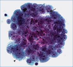Most tumors arise from the pleura, and so this article will focus on pleural pleural effusions are seen in the vast majority of patients at some stage during their disease 20. Mesothelioma Basicmedical Key