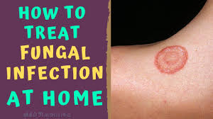 Tips on how to treat a yeast diaper rash when nystatin doesn't work. How To Treat Skin Fungal Infection Infection At Home Tinea Ringworm Remedies How To Cure Youtube