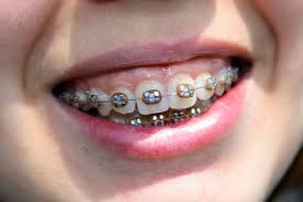 How to correct overbite with braces. Why Ignoring Your Overbite Can Lead To A Slippery Slope