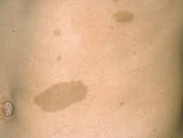 What is neurofibromatosis type 1 (nf1)? Neurofibromatosis Dermnet Nz