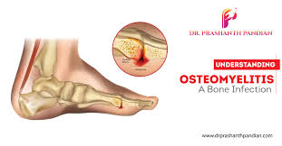 Image result for Osteomyelitis