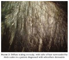We did not find results for: Scielo Brasil Pityriasis Amiantacea Clinical Dermatoscopic Features And Microscopy Of Hair Tufts Pityriasis Amiantacea Clinical Dermatoscopic Features And Microscopy Of Hair Tufts