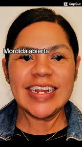 🦷 De mordida abierta a una sonrisa perfecta ✨📌 Antes: dificultad para  masticar y hablar correctamente.📌 Después: una sonrisa funcional y  armónica.💡 La ortodoncia no solo alinea dientes, también mejora ...