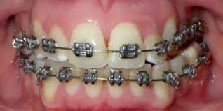 The most common type of orthodontic appliance, braces are suitable for children, teenagers and adults. How Much Do Braces Cost
