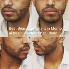How is hair transplant costs calculated? Beard Transplant Mumbai Cost Beard Transplant Clinic Mumbai