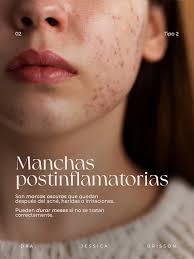 🔬 Cada piel tiene su historia… y también sus retos. Manchas, marcas de  acné, tono desigual, textura áspera o poros dilatados son más comunes de lo  que crees. Lo importante es saber